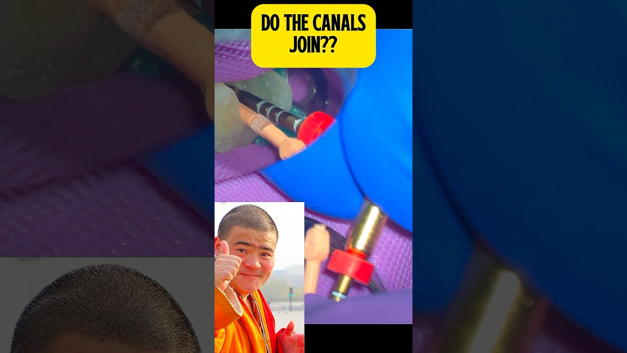 Endodontic Obturation Tip #1