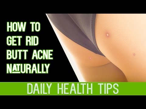 How To Get Rid Of Butt Acne Naturally - How To Treat Acne on Buttocks - How To Eliminate Butt Acne