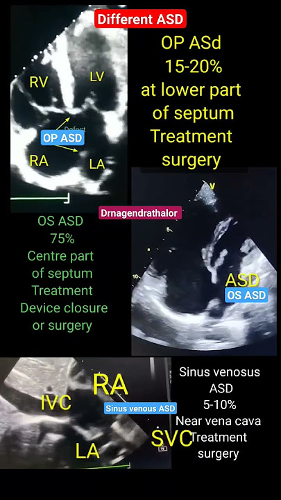 Different types of ASD ( Atrial septal defect) Echo #asd #echo #shorts