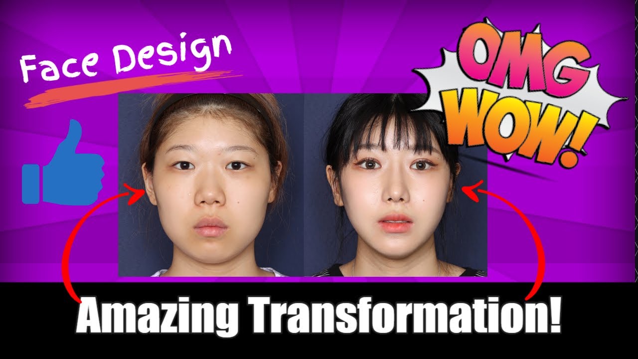 Unbelievable Before and After Rhinoplasty and Buccal Fat Removal