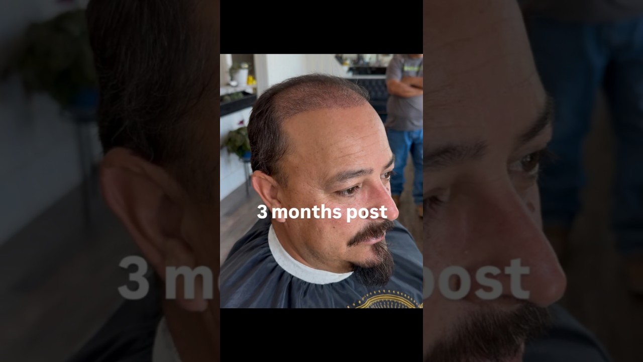 3 moths hair transplant update 