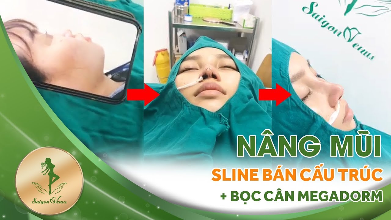 Nâng mũi bán cấu trúc - dáng Sline và bọc cân megadorm tại Thẩm mỹ viện Sài gòn Venus - YouTube