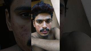 My acne transformation|like,share, subscribe| #malayalam #acnejourney #supportme #subacribe screenshot 1
