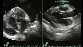 Echo Features of Tamponade