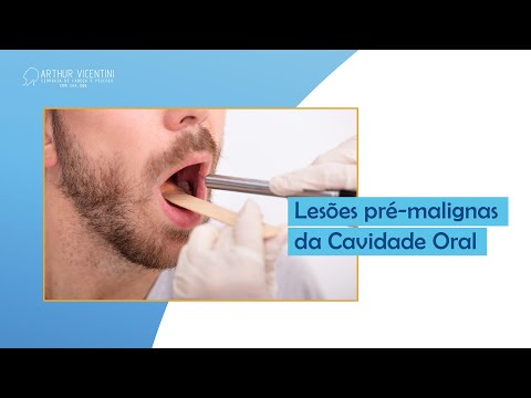 Lesões pré-malignas da Cavidade Oral | Dr. Arthur Vicentini CRM 154.086