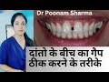 दांतों के बीच का गैप ठीक करने के तरीके | Close/Fill Gap In Teeth | How To Fix Gap Between Two Teeth