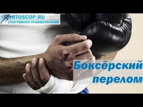 БОКСЁРСКИЙ ПЕРЕЛОМ.ПЕРЕЛОМ 5 ПЯСТНОЙ КОСТИ