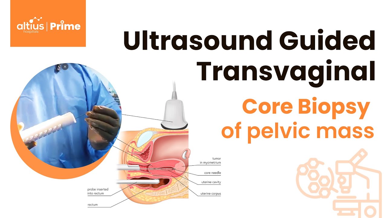 Ultrasound-guided transvaginal core biopsy | Dr. Muni Raju - YouTube