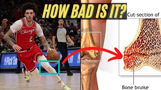 Expert Explains Lonzo Ball Injury (knee contusion) \& timeline scenarios