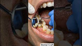 3D Tooth Decay Removal Animation  #satisfying #dentist