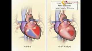 Celebrity How the heart and body compensate in heart failure - www.heartfailurematters.org Net Worth