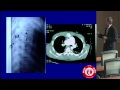 Treatment Decisions in Thoracolumbar Trauma: Operative or Non-operative? by Kirkham B. Wood, M.D.