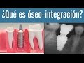 Qué es oseointegración |  Juan Fernando Salgado | La oseointegración de los implantes dentales