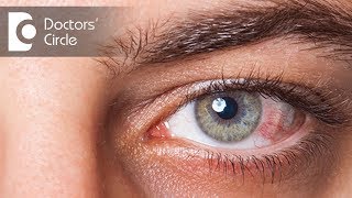 Preventing spread of Conjunctivitis & for how long is it contagious? - Dr. Sriram Ramalingam
