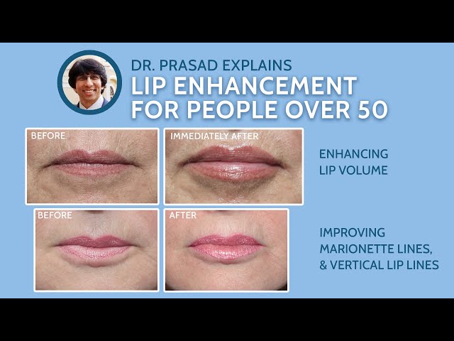 Lip Filler & Lip Augmentation - Lip Enhancement - The Aesthetics Doctor