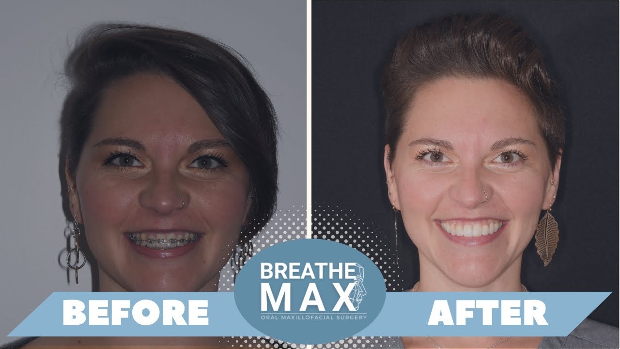 MMA Surgery Testimonial (post-op) - Dr. Kevin Coppelson at The Breathe Institute