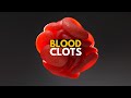 Blood Clots, Causes, Signs and Symtpoms, Diagnosis and Treatment.