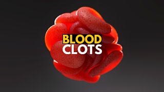Blood Clots, Causes, Signs and Symtpoms, Diagnosis and Treatment.