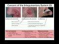 Anatomy | The Three Types of Skin Cancers