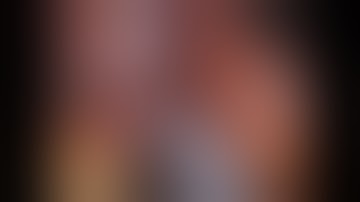 Robotic bile duct resection for Type I Klatskin tumour