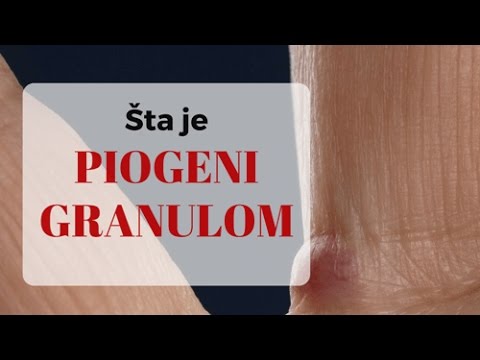 Video: Šta je piogeni granulom?