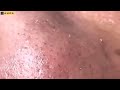 💥 MASSIVE BLACKHEADS &amp; ACNE REMOVAL | SATISFYING EXTRACTIONS