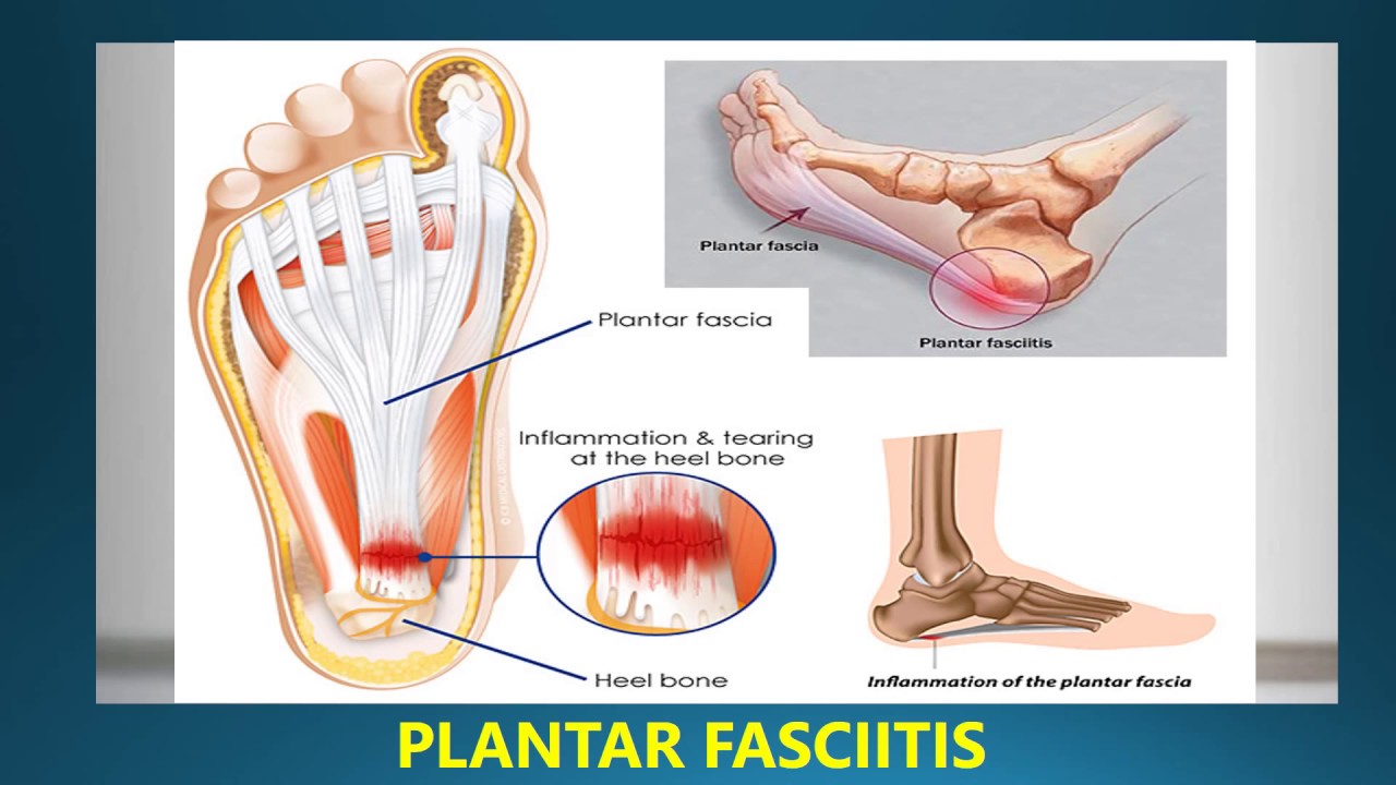 best orthotic for plantar fasciitis