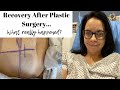 PLASTIC SURGERY AFTER WEIGHT LOSS...WHAT WAS THE RECOVERY REALLY LIKE? TRUTH TALK...