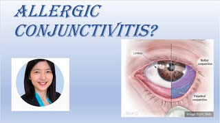 Dr. Ding | Allergic Conjunctivitis