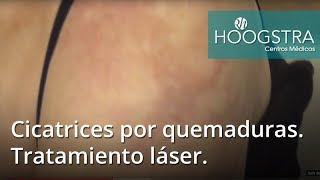 De cicatrices para de la en el costo india las láser con tratamiento quemaduras