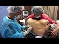 他院の再手術！現役ナースさんの背中の取り残された皮下脂肪を再度根こそぐ！術中劇的変化