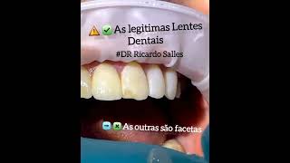 As  verdadeiras lentes dentais de porcelana