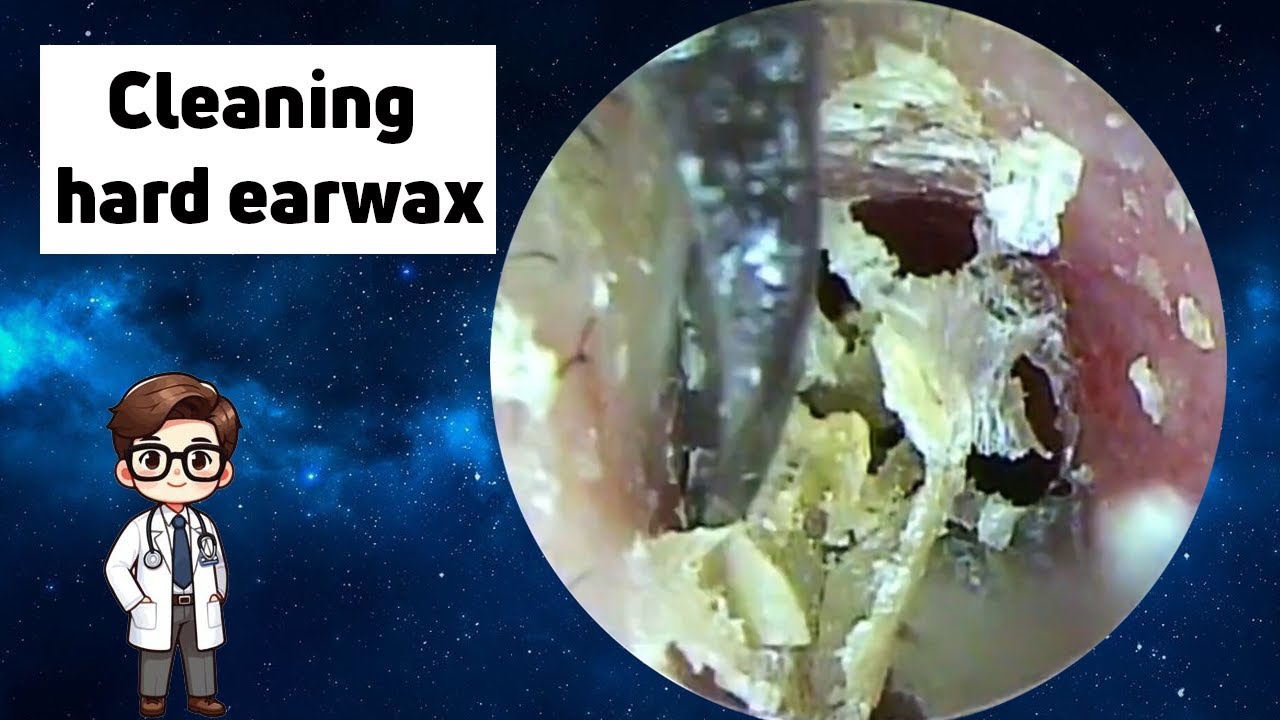 A lot of cleaning process of fine earwax - deep ear cleaning - ASMR ear ...