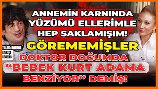 Çocuklar Beni Uzaylı Sanıyor Annemin Karnında Yüzümü Ellerimle Hep Saklamışım Görememişler