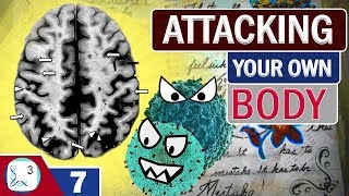 Causes &Types of Multiple Sclerosis | Latest Multiple Sclerosis Research