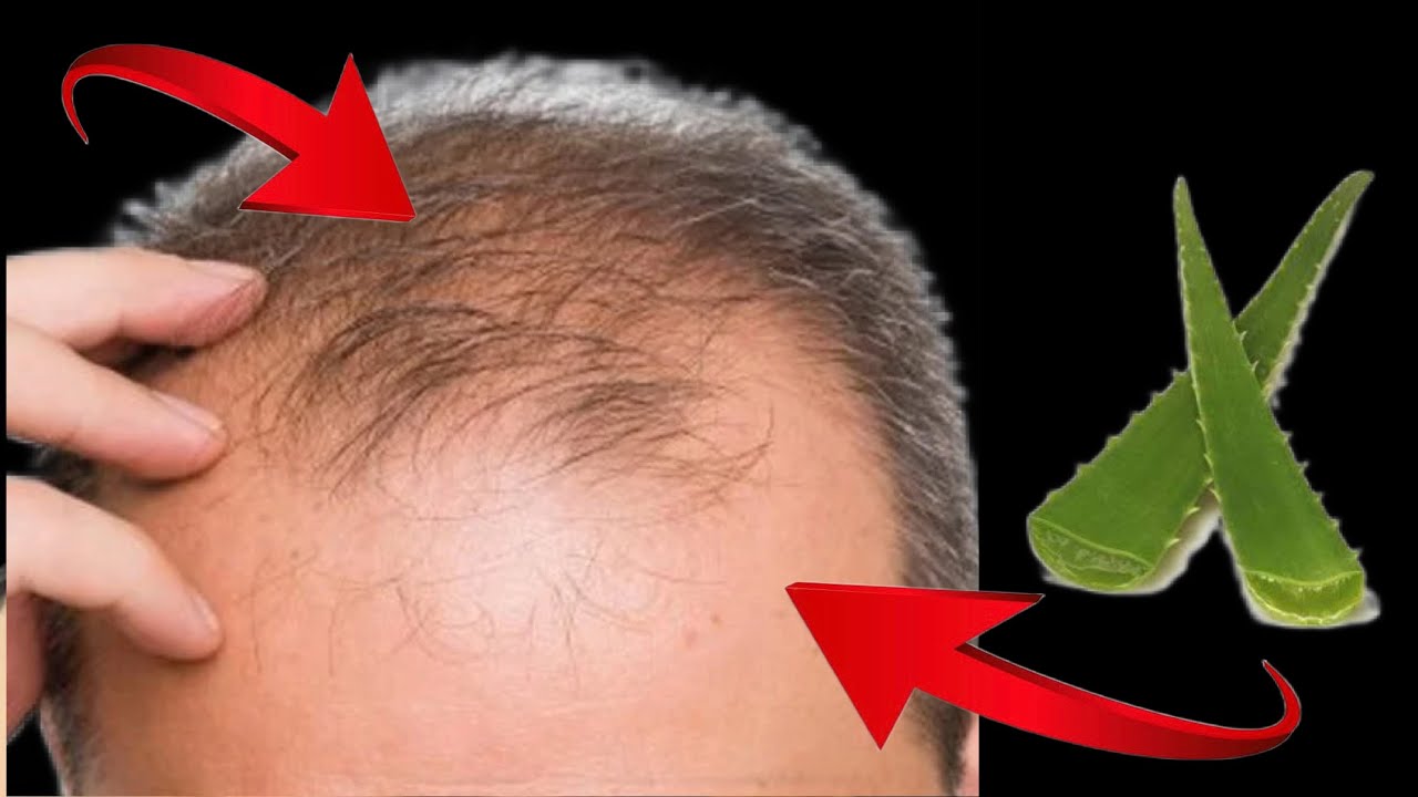 This aloe vera Trick-Turned My Bald Hair to Thick Heavy Hair- 30 Days ...