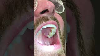 Mouth Pimple Pop