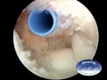 Elbow arthroscopy