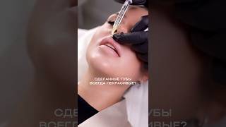 Контурная пластика губ #косметология