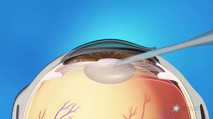 Laser-assisted Refractive Lens Exchange