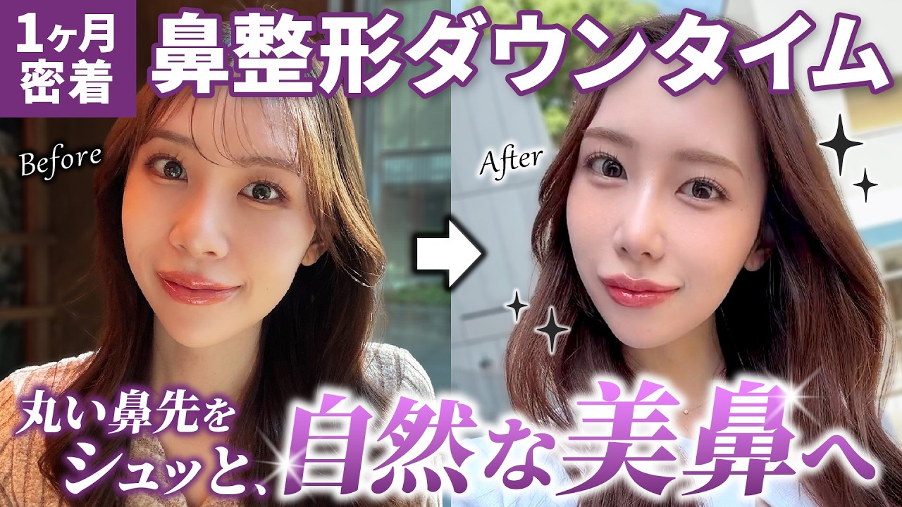 I got a nose job] The realistic downtime of nose surgery