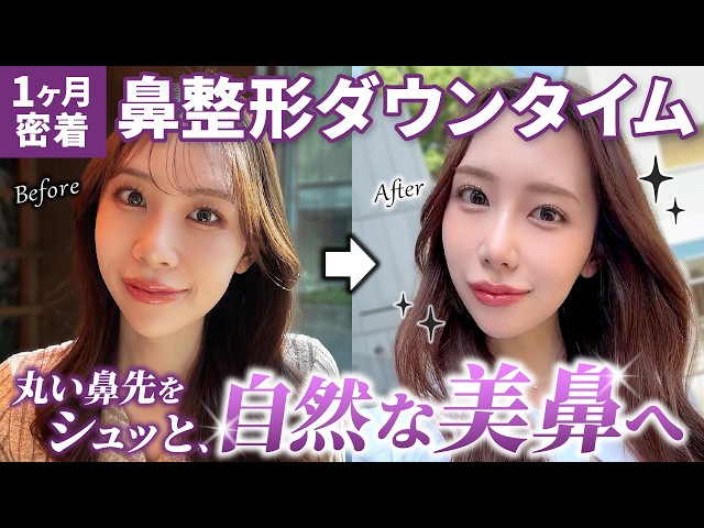 I got a nose job] The realistic downtime of nose surgery