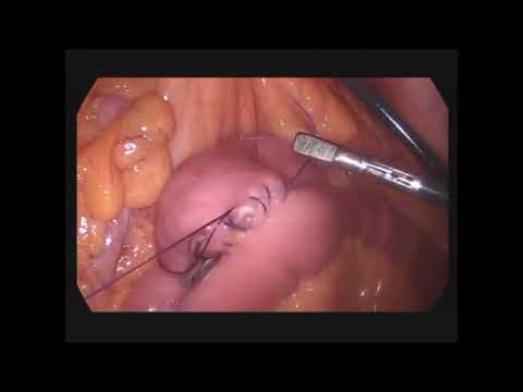 Laparoscopic Roux-en-Y Gastric Bypass (Graphic)