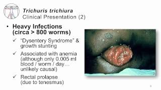 Helminths Trichuris