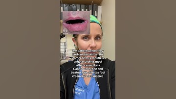 Angular cheilitis often occurs with dentures, or sagging of the mouth from age #angularcheilitis