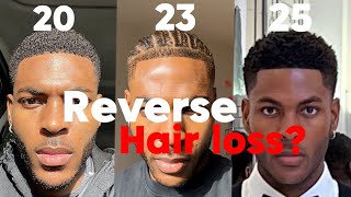 STOP hair loss in your 20s ( NO HAIR TRANSPLANT )