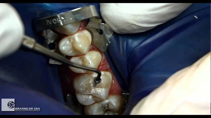 Restorative Procedure by Dr. Douglas Terry