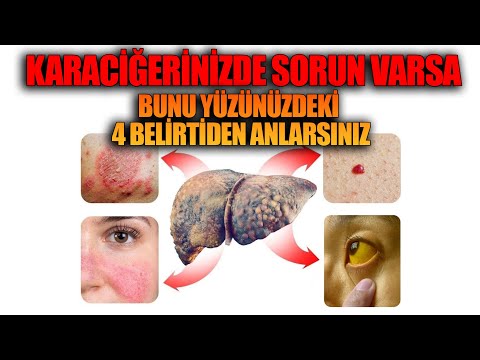 Karaciğerimizde sorun varsa bunu yüzünüzdeki 4 Belirtiden Anlarsınız.