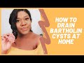 BARTHOLIN CYST: Home Remedy + How to Drain |  My Story