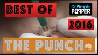 Dr Pimple Popper's Best Punch Removals of 2016